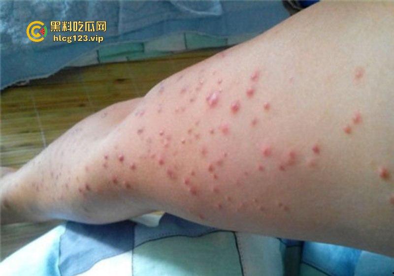 可怕!为了报复社会把带血针头扎进了共享单车的座椅里……山东商业技师学校20个被感染艾滋!!!