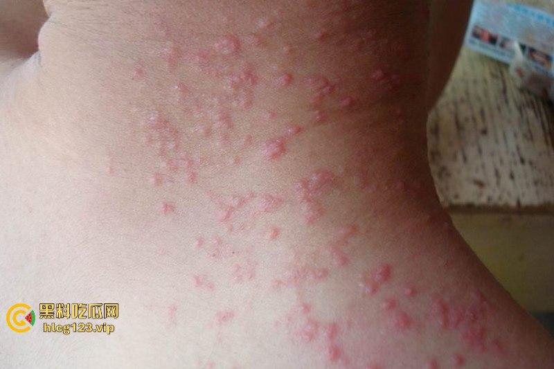 可怕!为了报复社会把带血针头扎进了共享单车的座椅里……山东商业技师学校20个被感染艾滋!!!