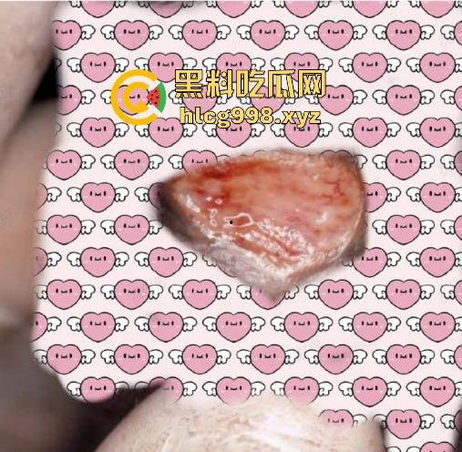 梅毒像疯狗一样乱咬!日本疫情横扫全球,日本卫生部出狠招断根大法安排上,管不住下半身只能禁爱?