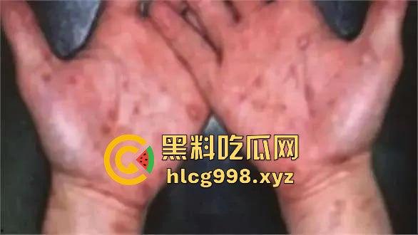 梅毒像疯狗一样乱咬!日本疫情横扫全球,日本卫生部出狠招断根大法安排上,管不住下半身只能禁爱?