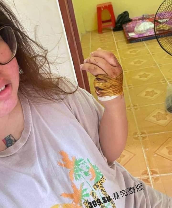 中国女孩王某被人诱骗到柬埔寨 后遭越南人绑架 被切掉一根 手指,并拍摄下视频威胁其国内家人勒索500万